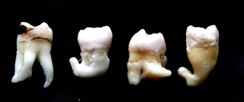 Операция «Ликвидация»: до и после удаления зуба
